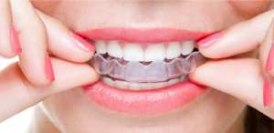 Invisalign Retainer What Is It and Why Does It Matter 8553 300x146 - Invisalign Retainer: What Is It and Why Does It Matter?
